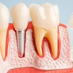 How to Care for Dental Implants