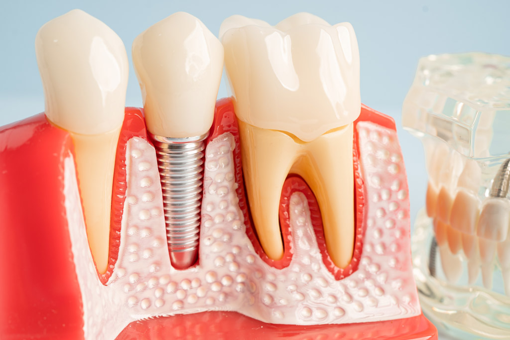 How to Care for Dental Implants