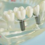 How Many Days Should You Rest After Getting a Dental Implant?