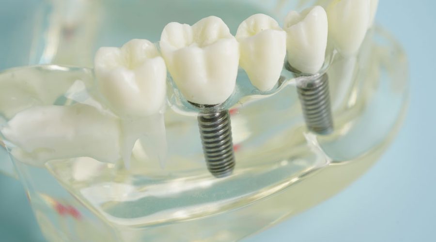 How Many Days Should You Rest After Getting a Dental Implant?