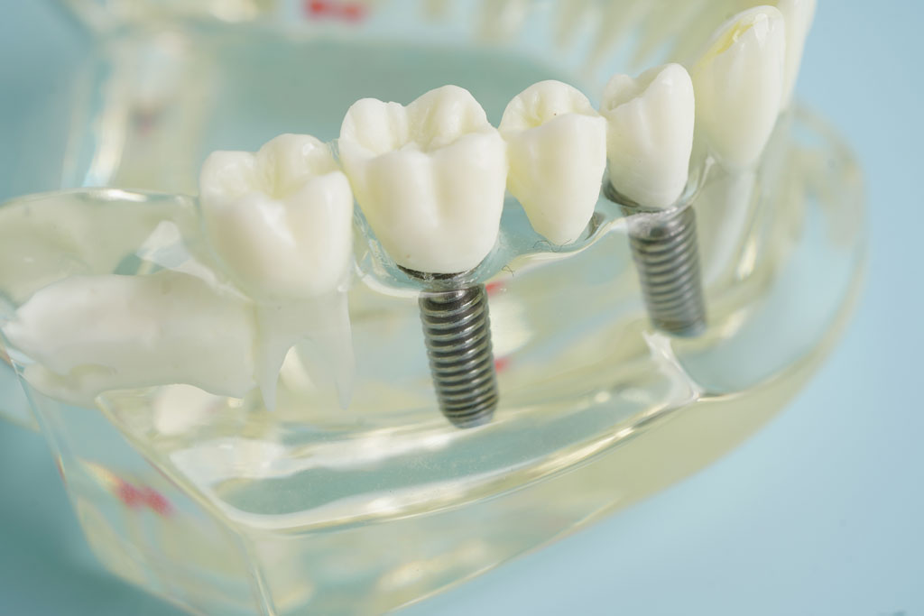 How Many Days Should You Rest After Getting a Dental Implant?